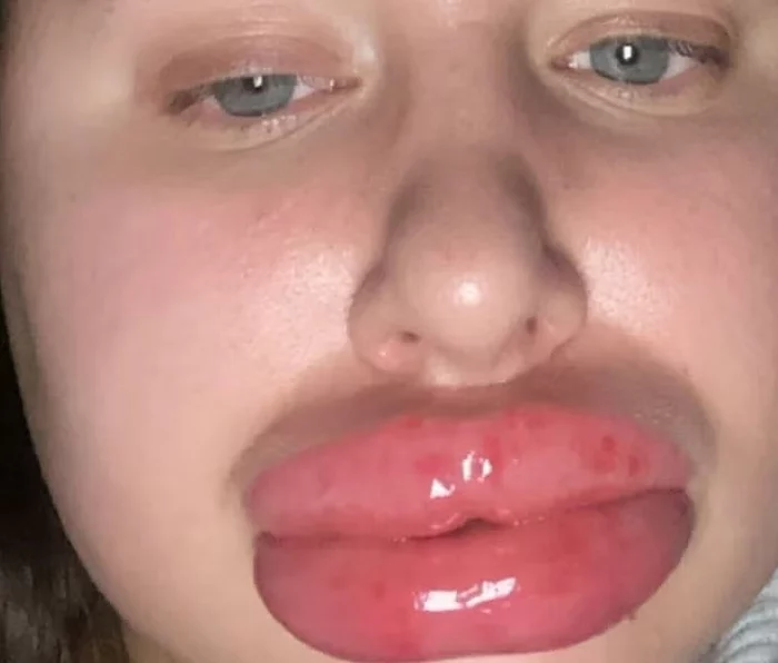 Hyaluronsöhne